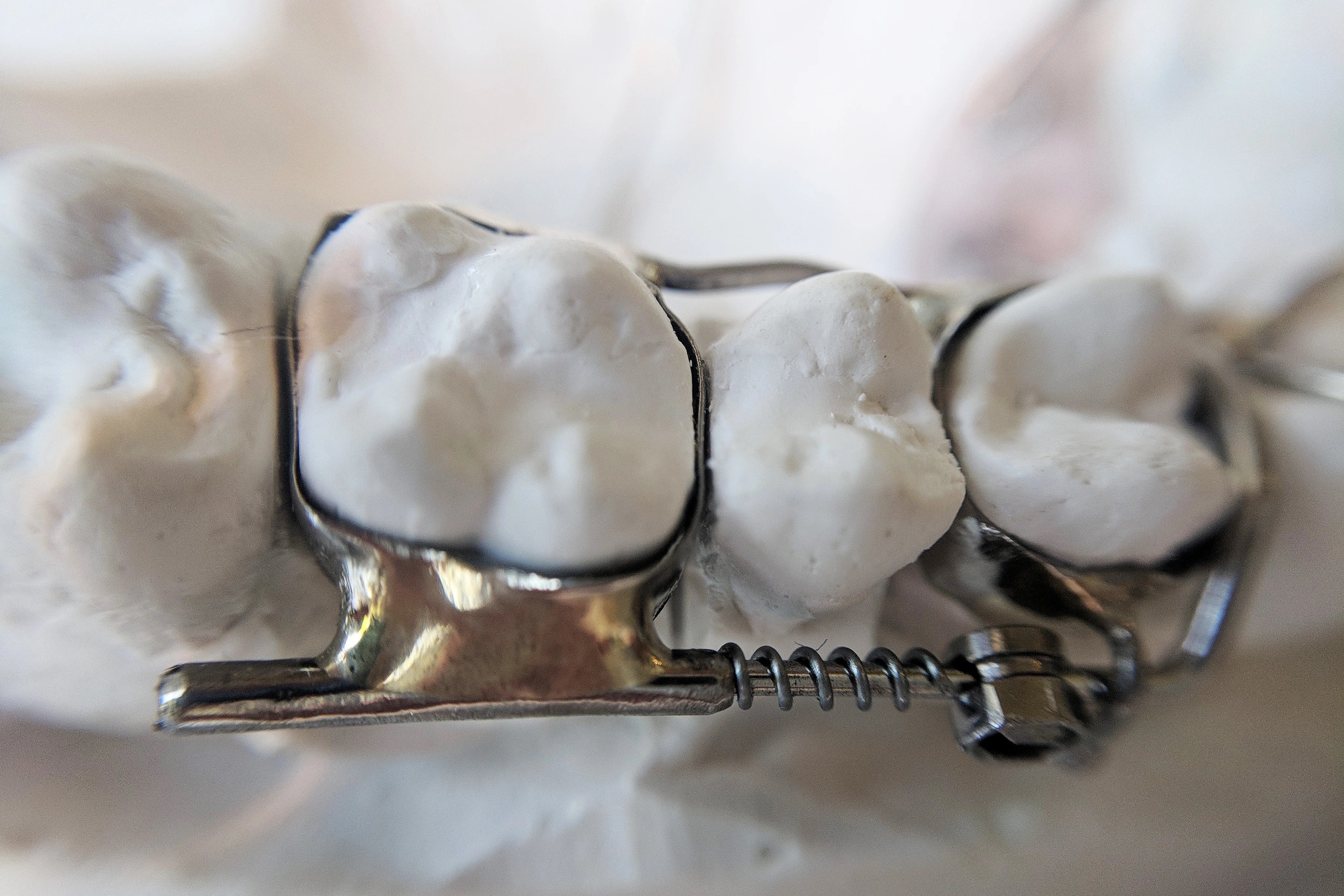 FDA looks into dental device after KHN-CBS News investigation of patient harm - Vimarsana News