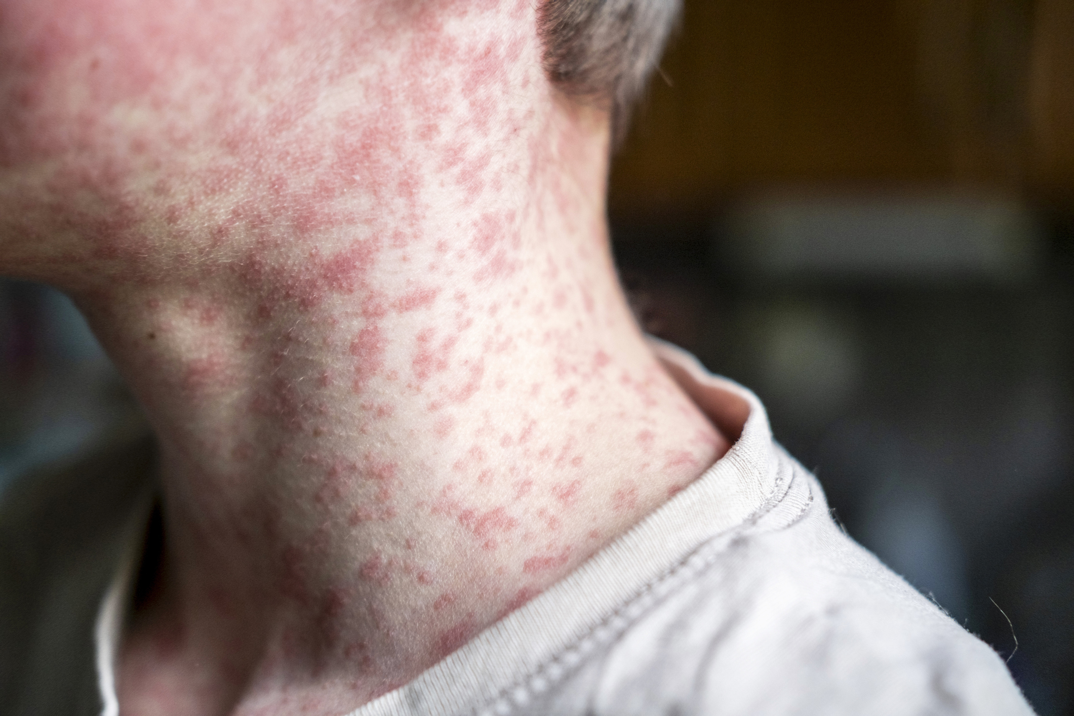 Measles alerts issued in San Antonio, New Braunfels and San Marcos as Texas  outbreak spreads | TPR