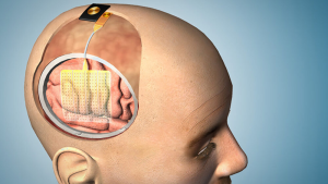 This illustration demonstrates how the thin film of sensors could be applied to the brain during surgery.