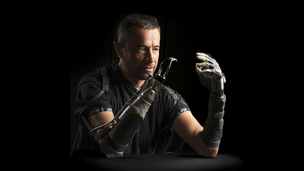 Samoana Matagi was one of the four participants in a study that tested the capabilities of a new bionic hand. Here, Matagi wears the bionic hand on one arm and a common prosthetic called a body-powered hook on the other.