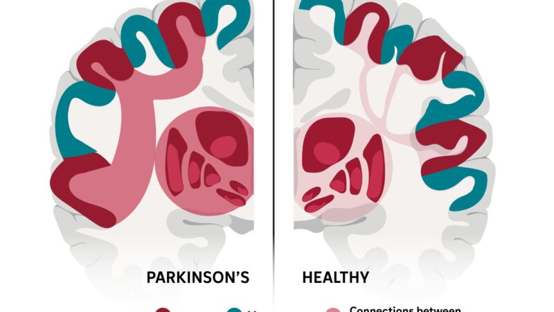 The SCAN network, which links movement and thinking, appears to be a key brain area affected in Parkinson's disease.