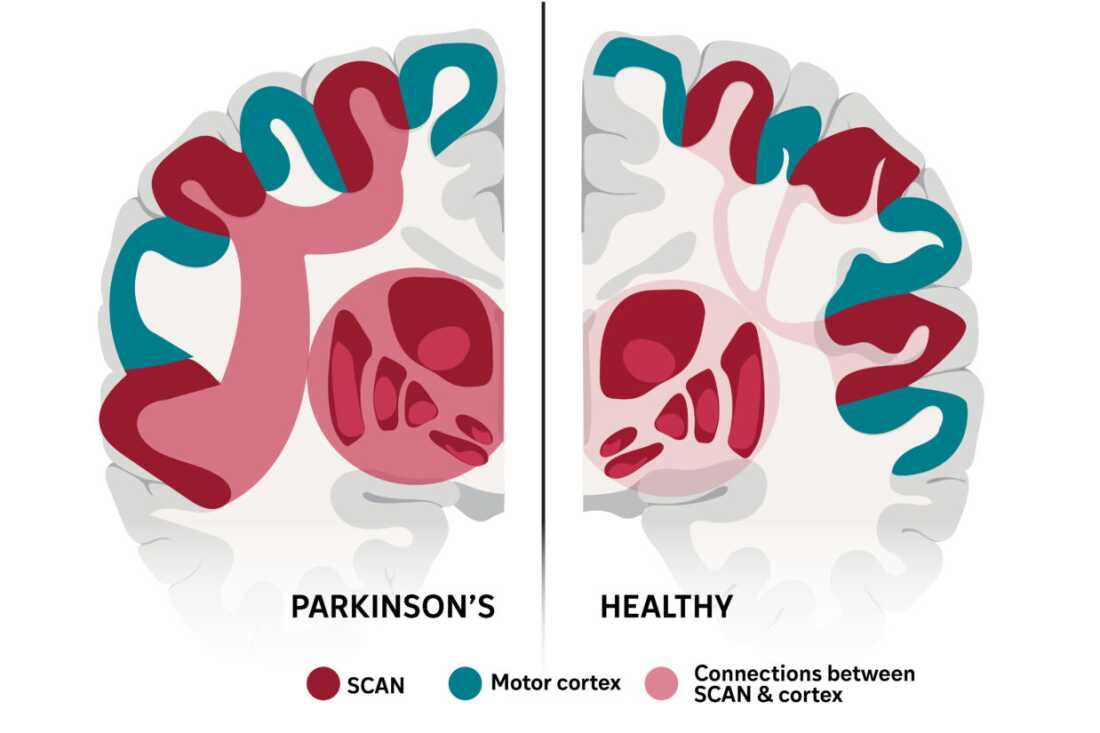The SCAN network, which links movement and thinking, appears to be a key brain area affected in Parkinson's disease.