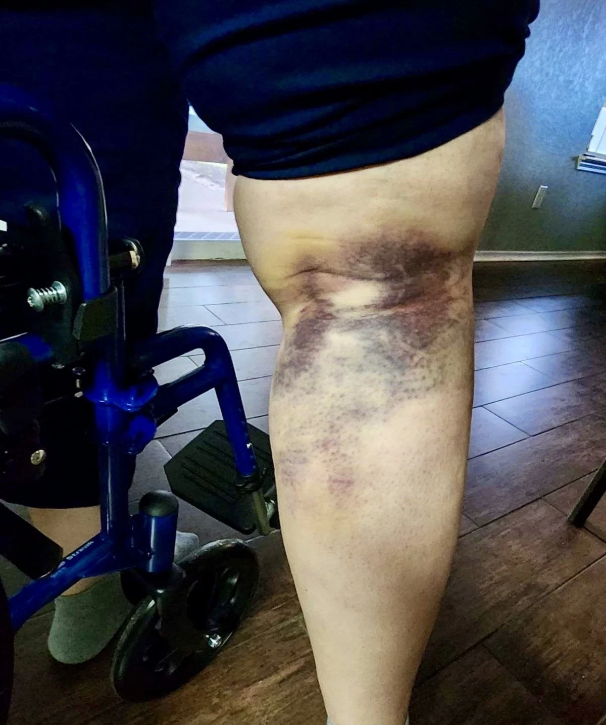 A Northside special education teacher who spoke to NPR on the condition of anonymity said her leg was injured so badly while a student was in the middle of an aggressive outburst that she required surgery. She provided this photo of the bruising that developed after the injury. She asked not to be named out of fear of retribution.