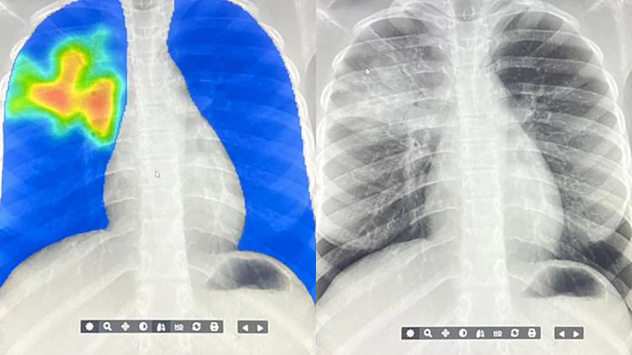 AI is stepping in to detect TB in regions with limited access to radiologists