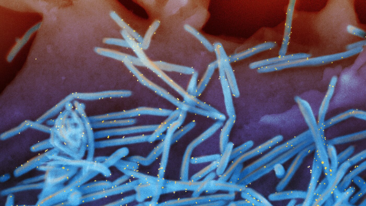 RSV pictures for infants underneath FDA assessment regardless of proof of security : NPR