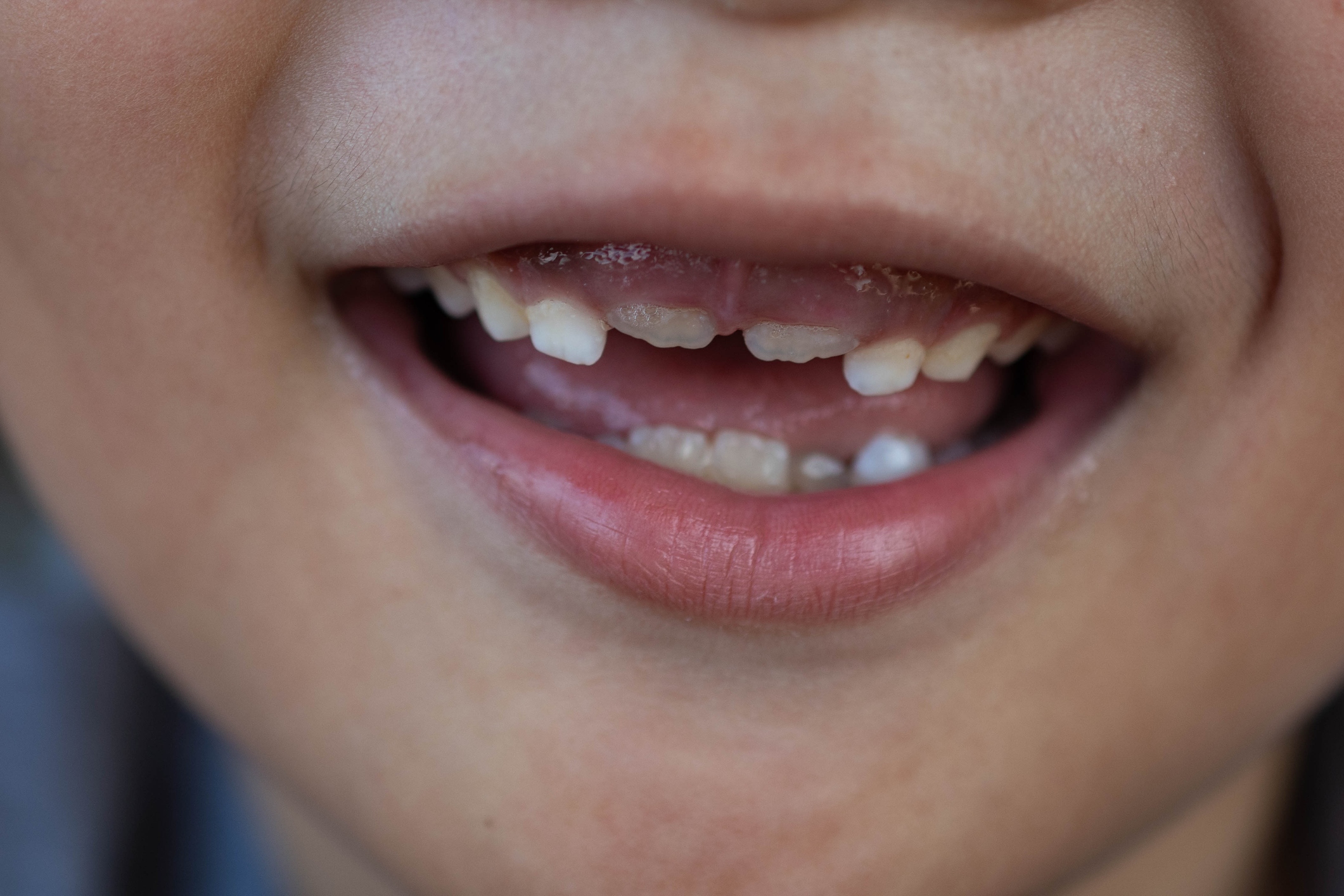 Dentists sometimes prescribe fluoride supplements to kids in areas that lack water fluoridation. FDA is taking action to remove such treatments from the market.