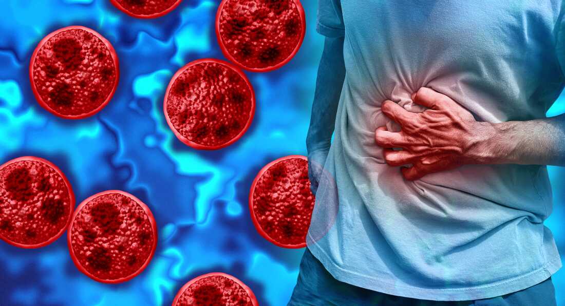 Cyclosporiasis is a parasitic illness caused by eating or drinking contaminated food or water.