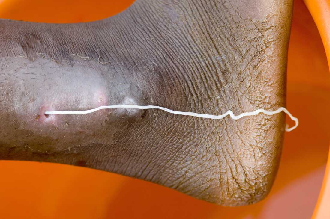 A patient with a guinea worm emerging, at the Savelugu Case Containment Center.