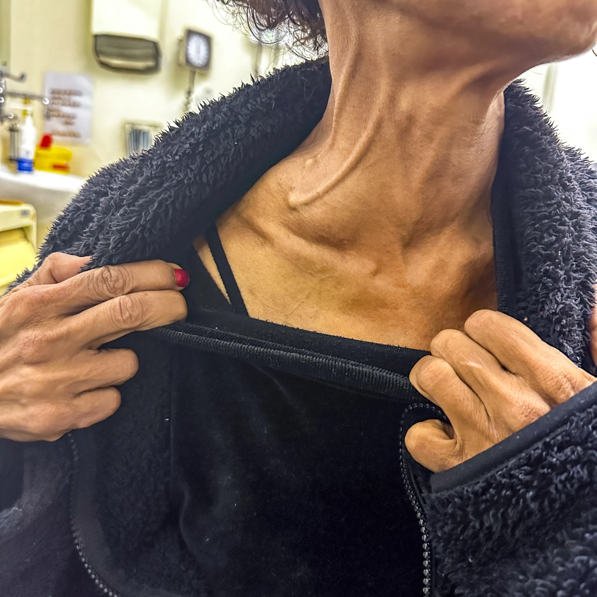 Eleanor Ceres shows the lung tumor that has protruded out of her neck. By the time she was diagnosed in April 2024, the cancer had advanced to Stage 4 and was terminal. Doctors could only offer palliative care, easing her pain.