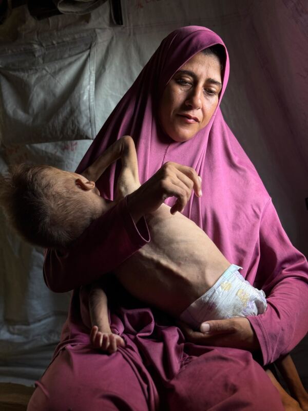 His name is Mohammad Al-Motawaq. He is 18 months old. And he is starving in Gaza