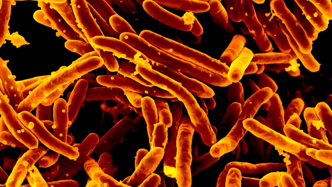 A fast and accurate TB Test that doesn't need phlegm : NPR