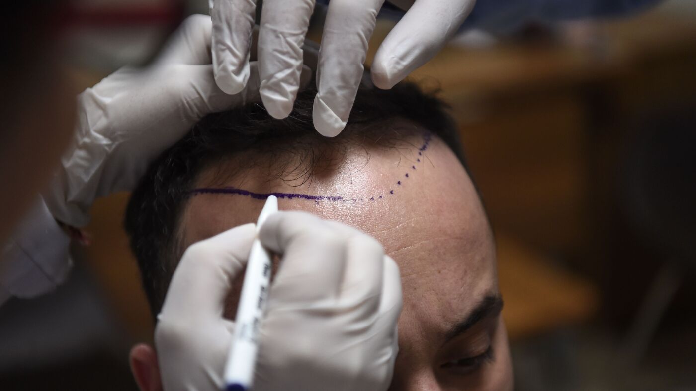 What makes this nation high vacation spot for hair transplants : NPR