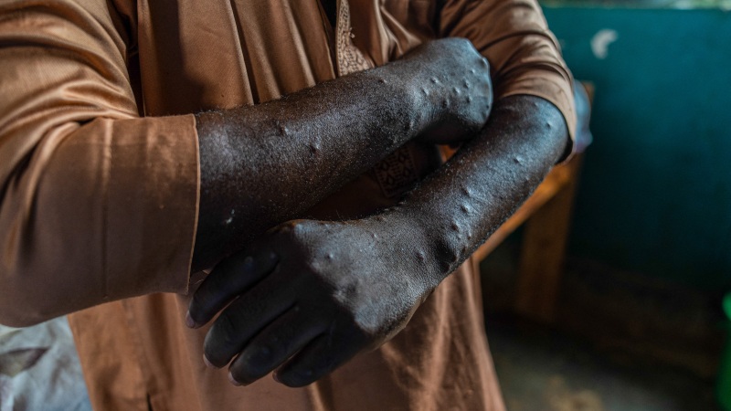 TOPSHOT - A patient infected with mpox shows lesions on his body at the treatment centre in Kamituga, South Kivu province in the east of the Democratic Republic of Congo on September 20, 2024. Kamituga, one of the localities hardest hit by the epidemic with around a thousand confirmed cases, will be one of the first to receive the doses, according to the provincial health authorities. Kamituga, one of the localities hardest hit by the epidemic with around a thousand confirmed cases, will be one of the first to receive the doses, according to the provincial health authorities.