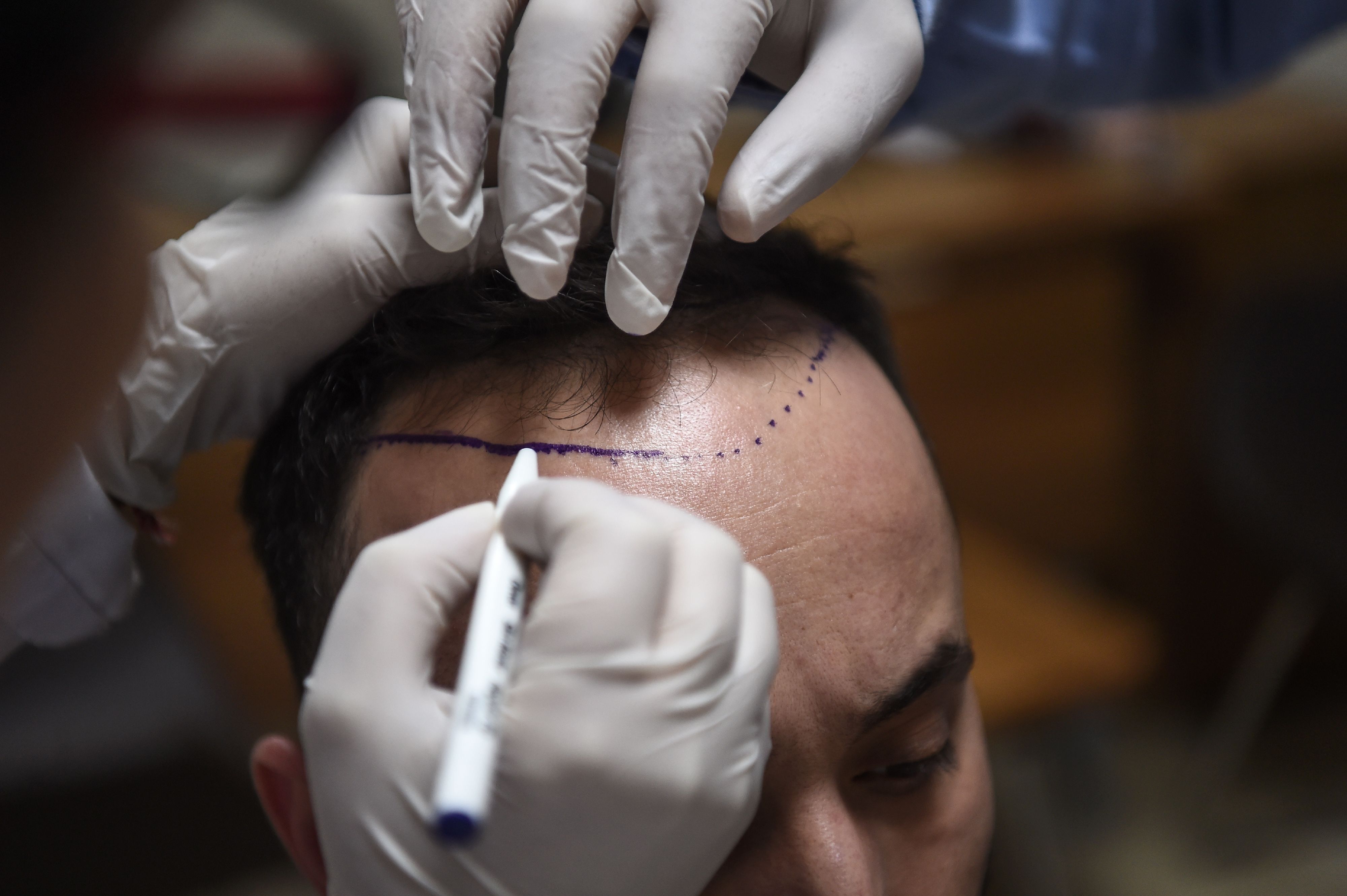 How one country has become a top destination for hair transplants