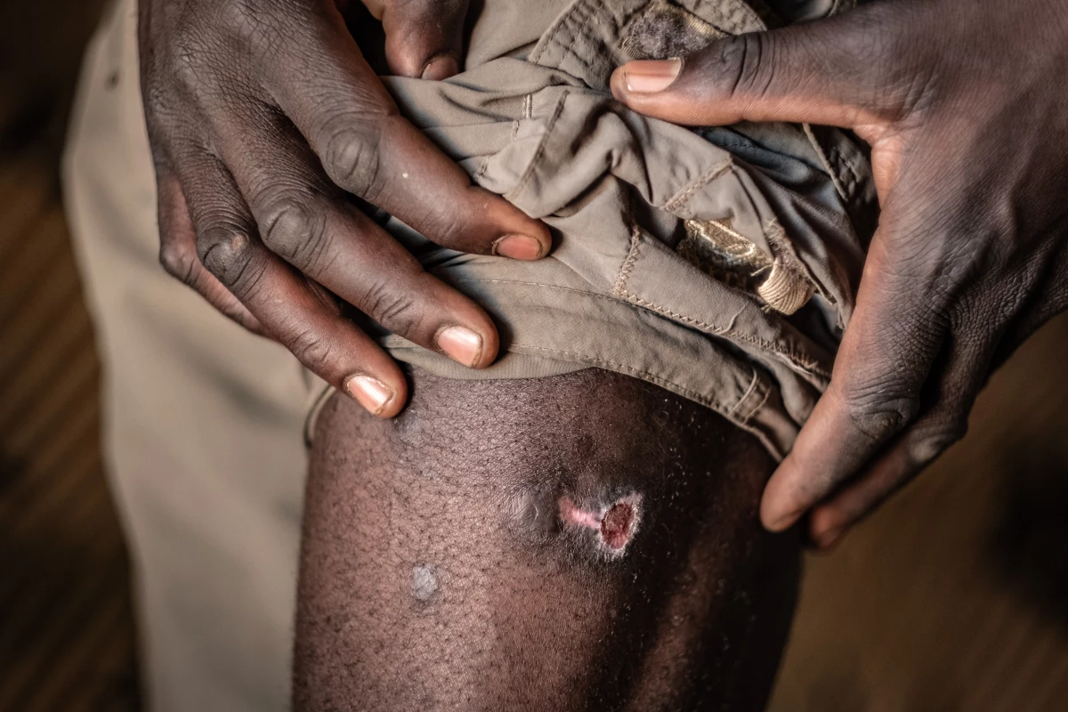 Bernard Muyondo, 34, displays one of several wounds he sustained during a recent elephant attack in the village of Simoonga, outside Livingstone. The attack left him unconscious and bleeding heavily.