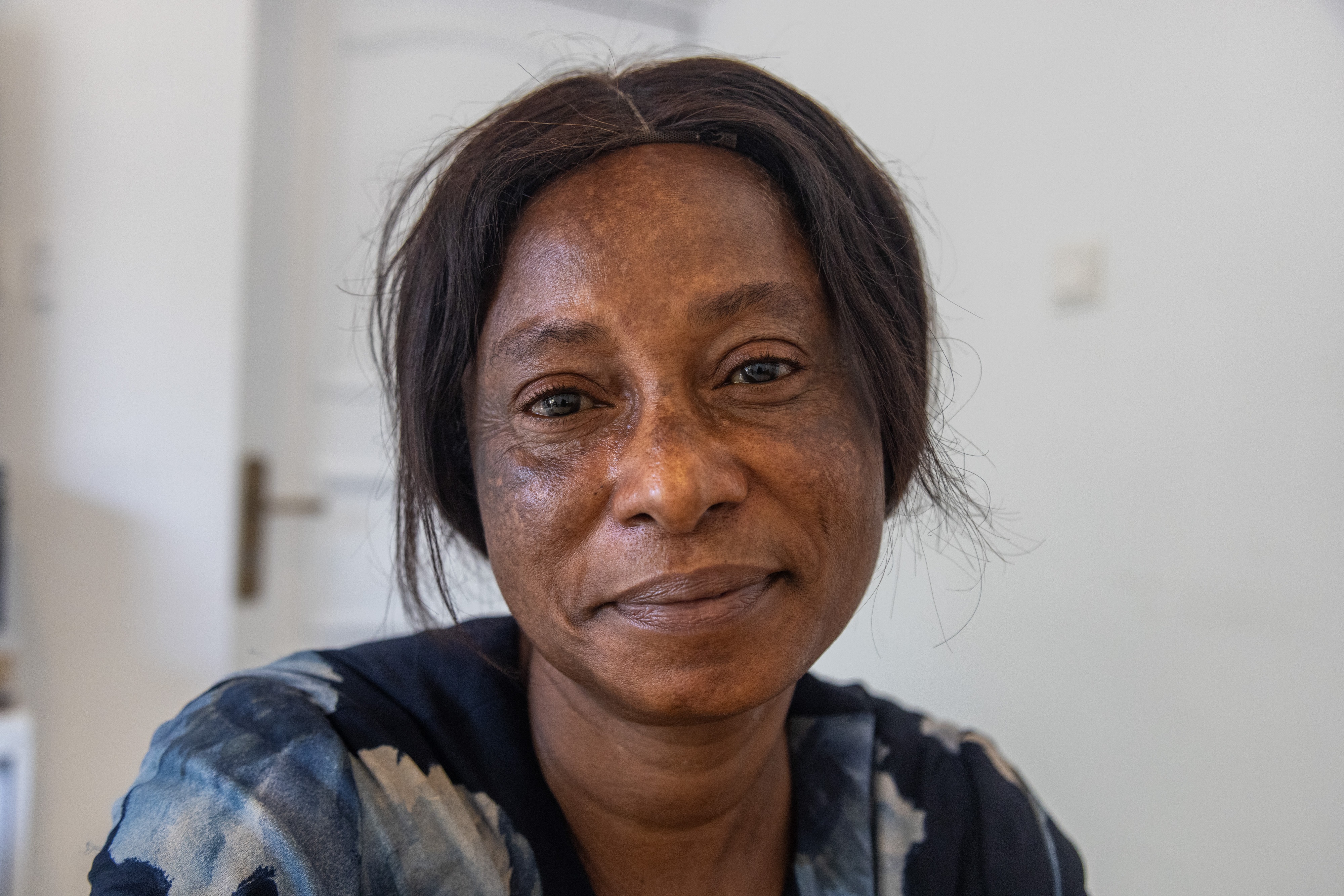 Susan Anderson began using skin lightening creams at age 12. Now 52, she has stopped using the products but her skin shows the damage they caused.