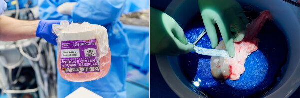 A surgical team flew to Revivicor’s research farm in rural Virginia and brought back two pig kidneys.