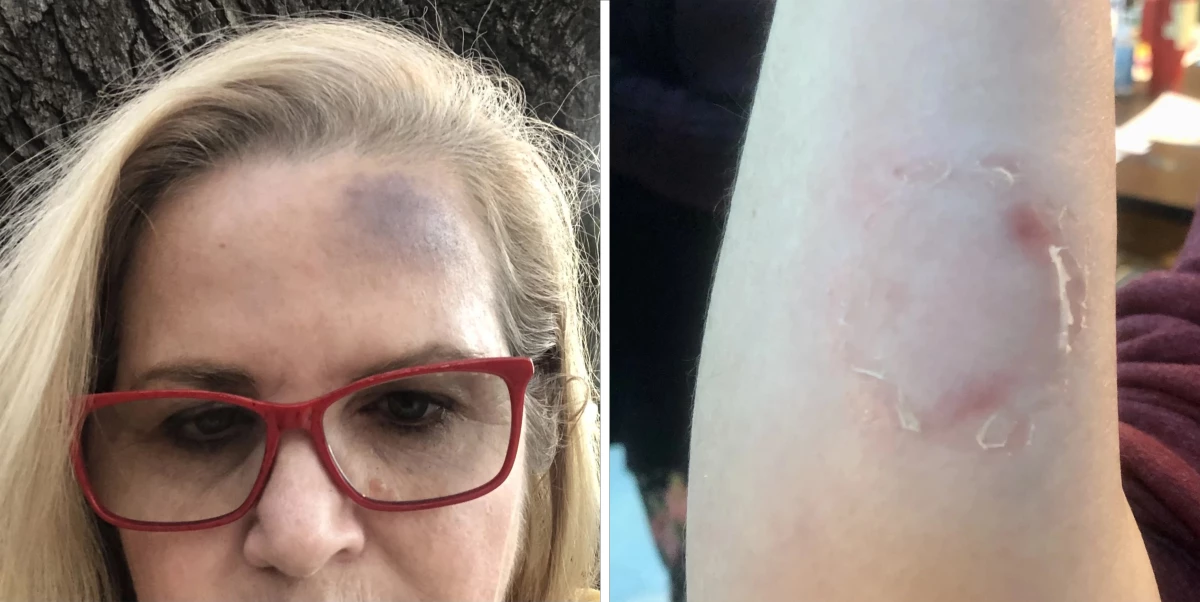 Kreusel has documented her injuries in photos. 'I've had three concussions,' she told NPR. She said her last concussion caused permanent nerve damage on her forehead. Kreusel has also documented bite marks and scars after being bitten by students.