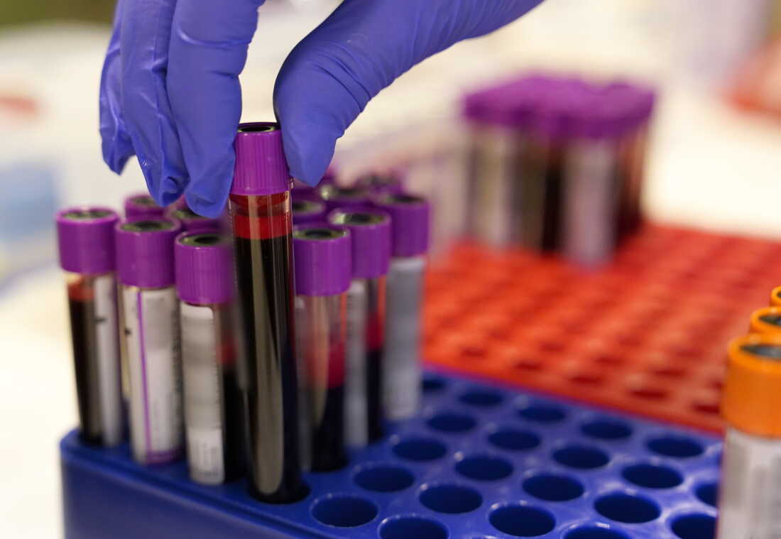 New blood tests that help detect Alzheimer's disease are opening up a new era in diagnosis and treatment, doctors say.