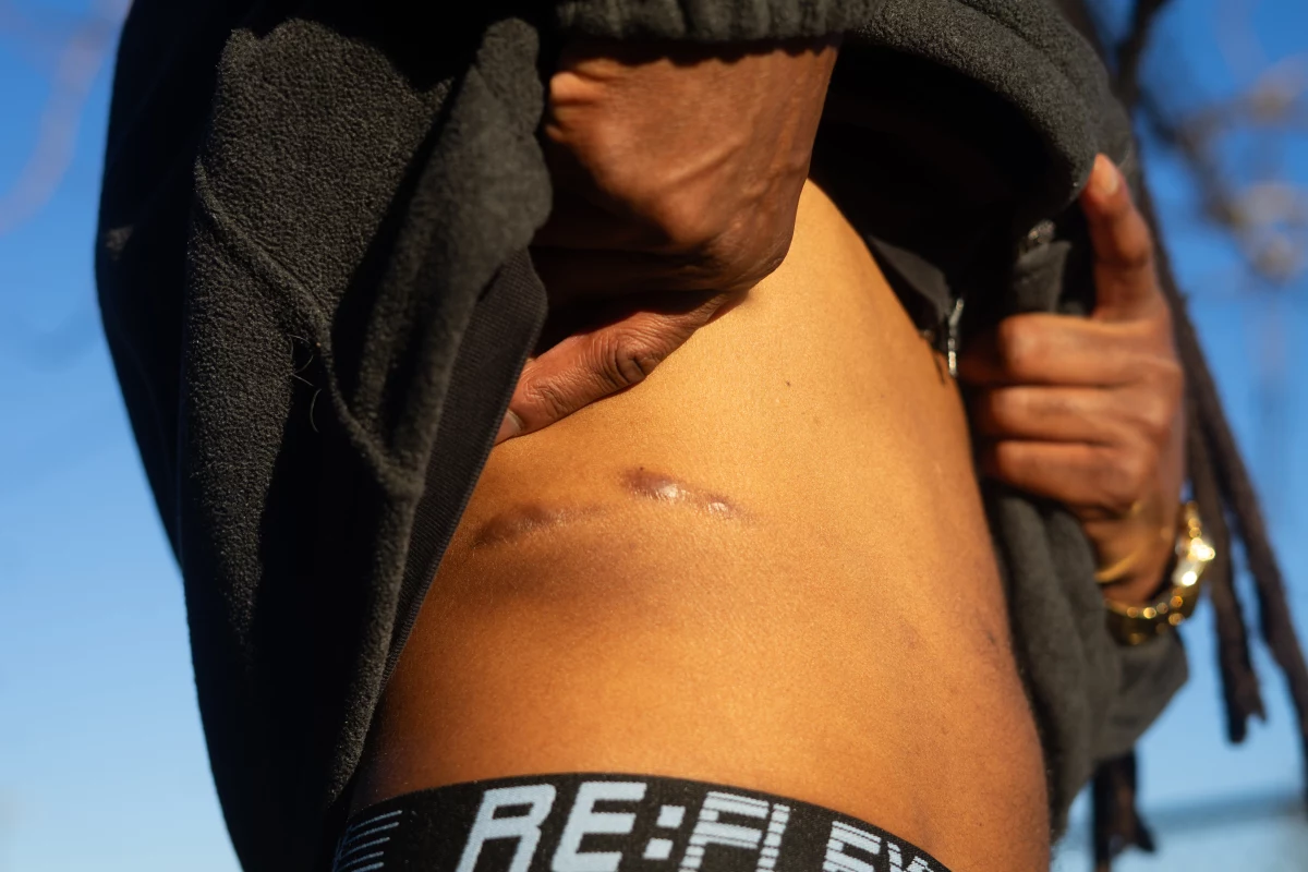 McNair bears scars on his stomach that he says are the result of harsh restraints used on him at USP Lee. He was shackled for roughly 17 hours, he said in a lawsuit.