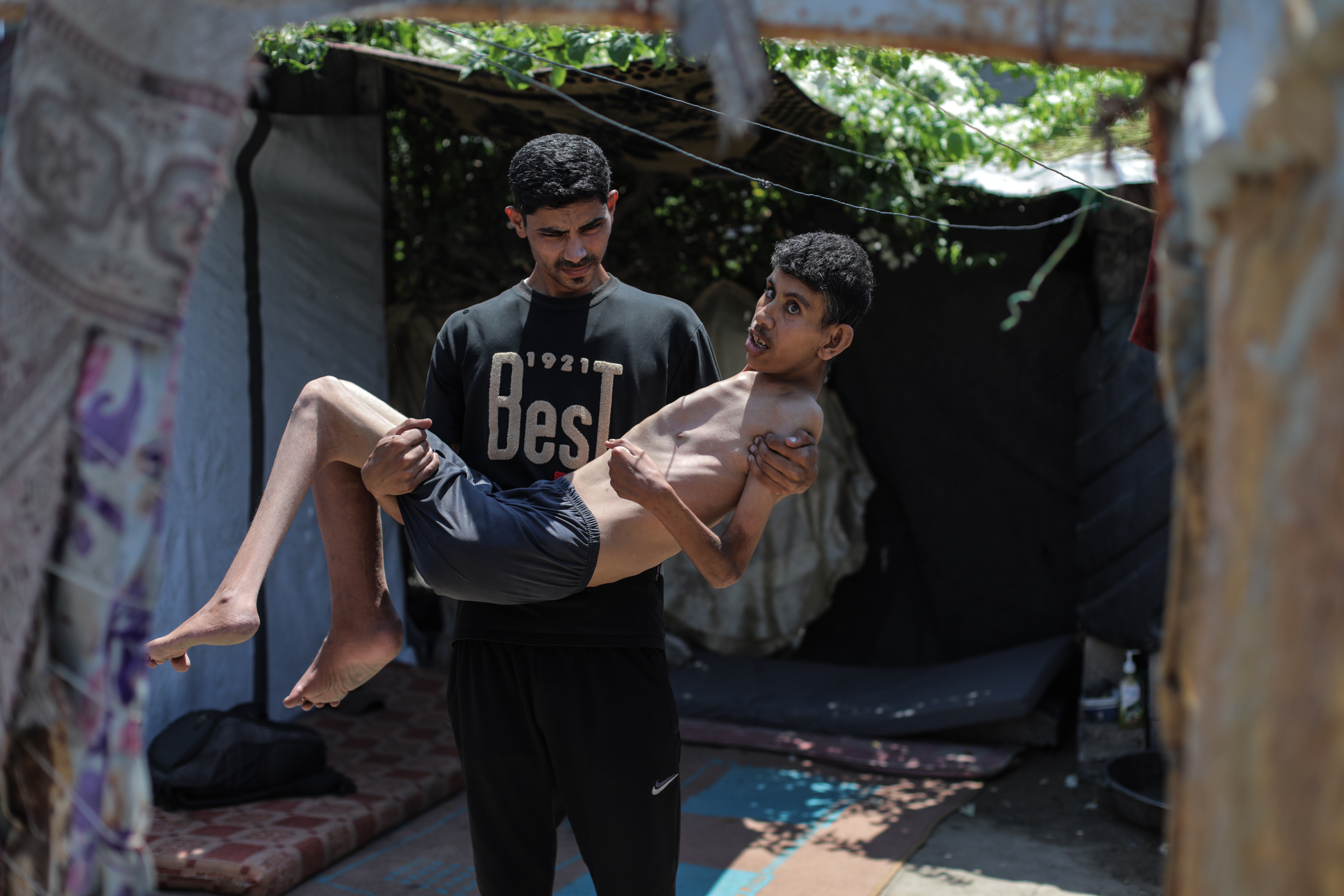 Hamza Mishmish, 25, of Gaza shows signs of severe malnutrition and bone loss in the Nuseirat refugee camp amid worsening hunger in the region. The date of the photo is July 27.