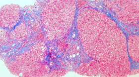 Cirrhosis of the liver as shown with staining.