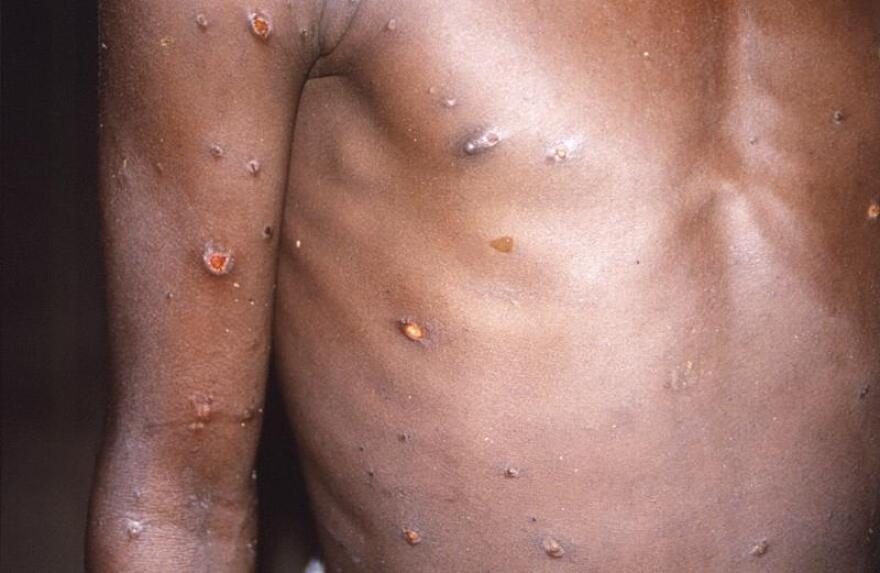 This 1997 image provided by CDC, shows the right arm and torso of a patient, whose skin displayed a number of lesions due to what had been an active case of monkeypox. As more cases of monkeypox are detected in Europe and North America in 2022, some scientists who have monitored numerous outbreaks in Africa say they are baffled by the unusual disease's spread in developed countries.