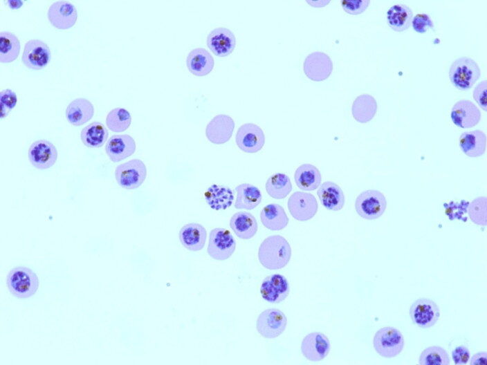A micrograph shows red blood cells infected by the malaria parasite <em>Plasmodium falciparum</em>.