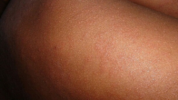 Stock image of a measles rash