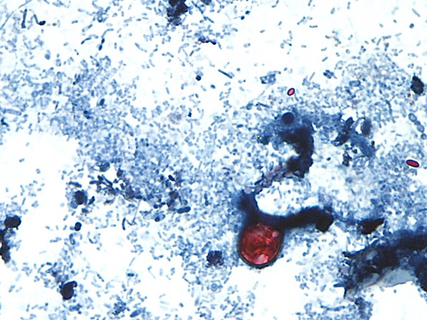 This undated photo taken through a microscope provided by the CDC shows Cyclospora cayetanensis oocysts found in a fresh stool sample which had been prepared with a formalin solution and stained with safranin.