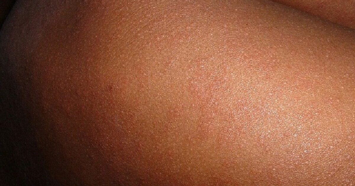 Kentucky health officials report measles exposures in Richmond, Olive Hill