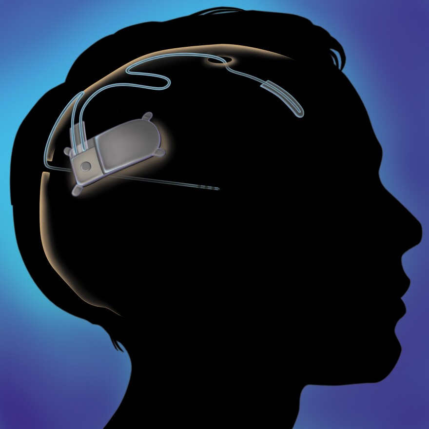 The device sits under a patient's skull and tracks brain activity.