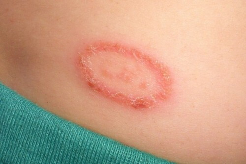 A flaky red circle is shown on the body of a person with ringworm.