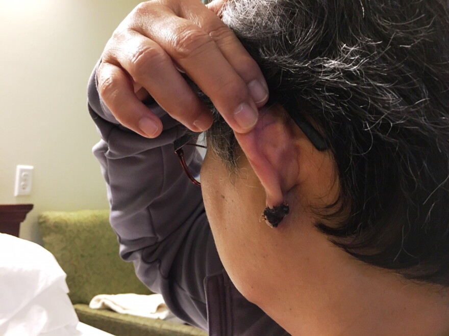 Berni, a nurse at Western State Hospital, shows where a patient bit off her earlobe during an assault in September.