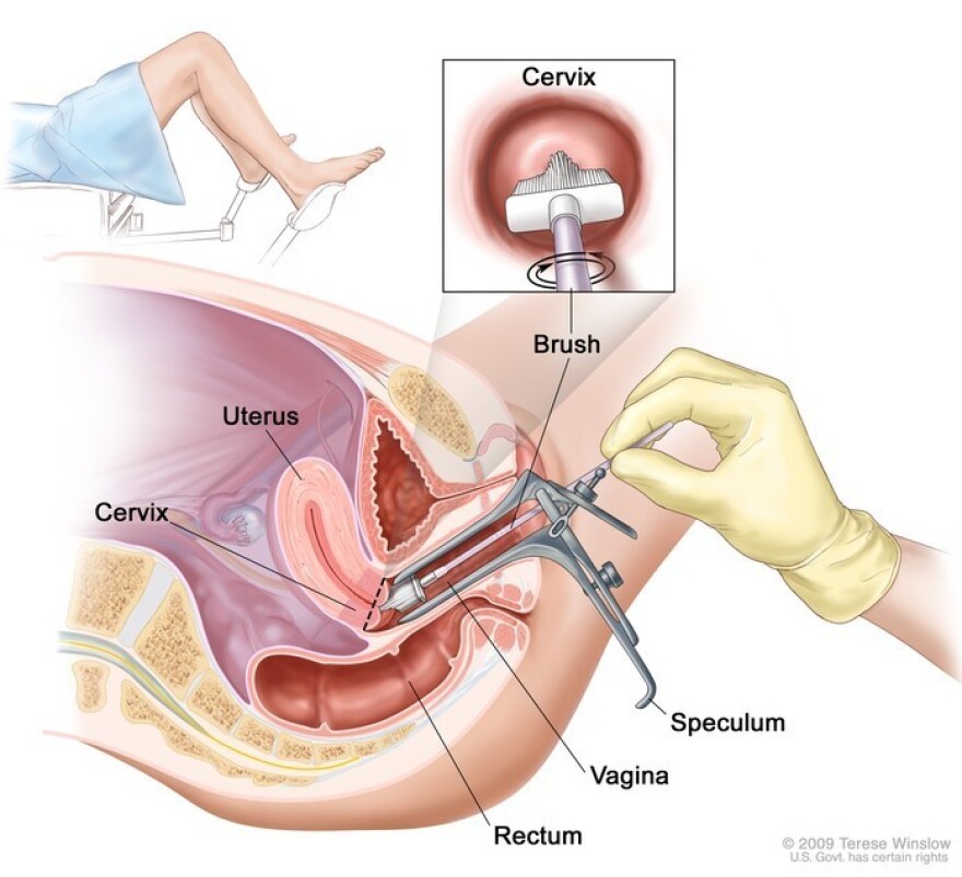 During a Pap smear, doctors collect cells from in and on the cervix to test for abnormal cells that might be cancer or lead to it.