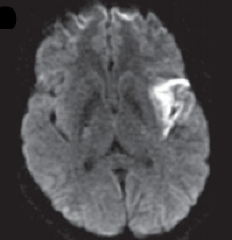 Another MRI of the woman's brain showed signs of a stroke in a region involved with language.