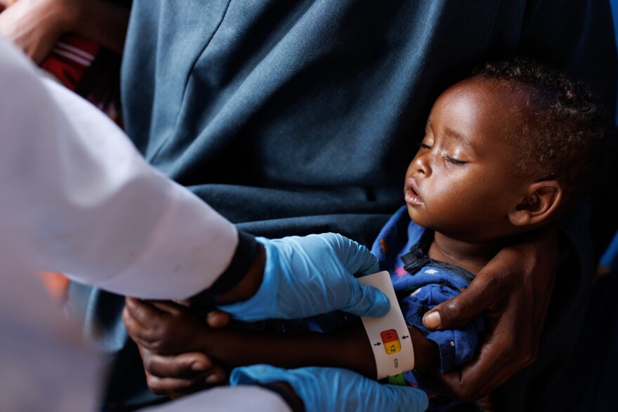 A child's upper-arm circumference is measured at a clinic in a camp for displaced people in Baidoa, Somalia. A measurement in the red indicates that the child has "severe acute malnutrition." Yellow means the child is at risk of acute malnutrition, and green indicates the child is well nourished.