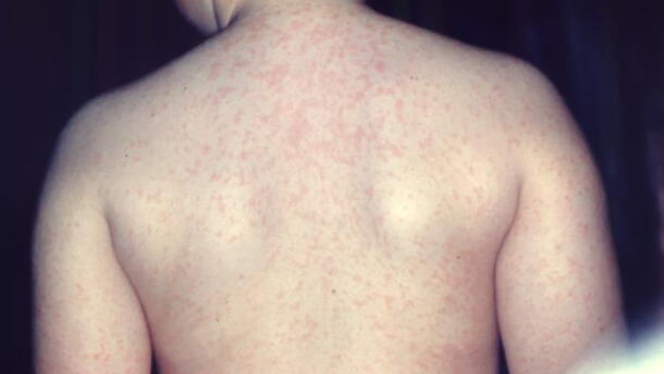 This photograph depicts a posterior view of a young patient’s back, highlighting an erythematous rash associated with measles.