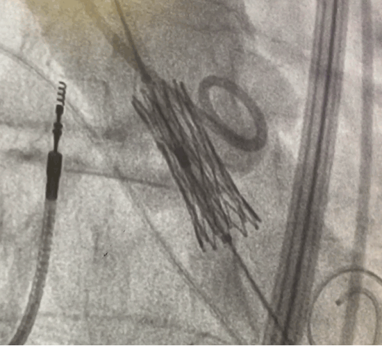 A replacement valve expands inside a patient's aorta at RGH.