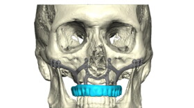 Lexington VA Healthcare staff are among the first in the United States to offer a new type of surgery for people with bone loss so severe they can't wear dentures.