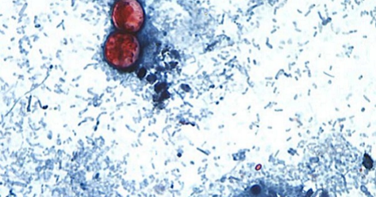 Missouri reports 43 cases of parasitic infection that’s sickened thousands nationwide