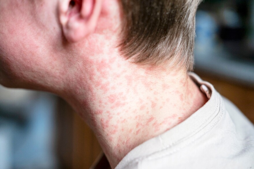 Teenager covered in measles rash.