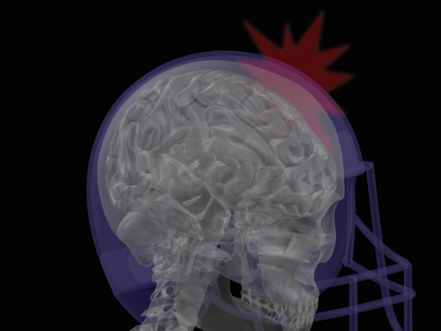 Researchers are studying athletes and military personnel to learn more about how a concussion can affect the brain's ability to understand sound.