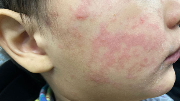 The child’s cheek shows the characteristic rash associated with measles.
