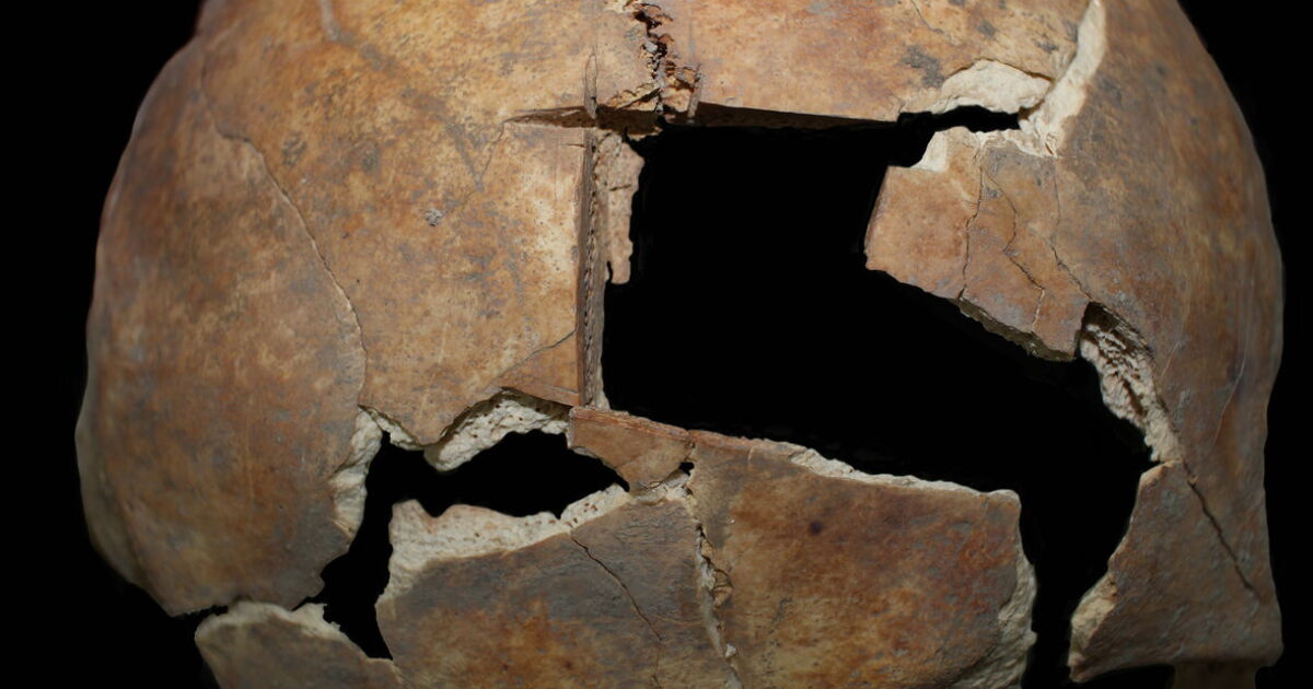 Clues to Bronze Age cranial surgery revealed in ancient bones