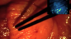 In the right hand corner, under fluorescent lamp, the cancerous tissue glows.