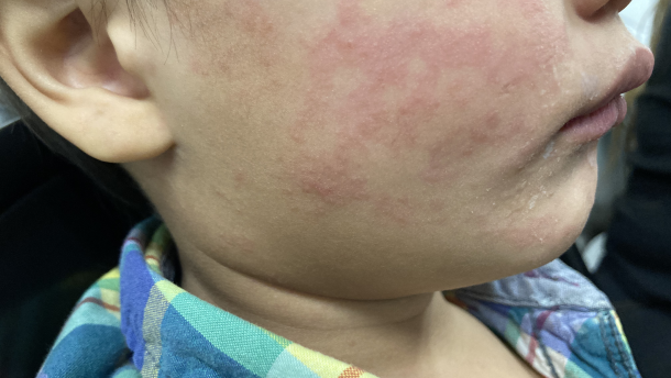This photograph, taken in the United States depicts a child who was infected with the Morbillivirus, also known as measles, or rubeola during a domestic outbreak in 2024. The child’s cheek shows the characteristic rash associated with this viral infection.