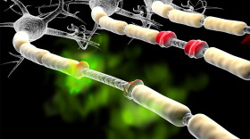 Initial tests in humans have found the substance acrolein – an excreted waste product – can accumulate in some people and damage the myelin, which surrounds the nerve cell like insulation on a copper wire.