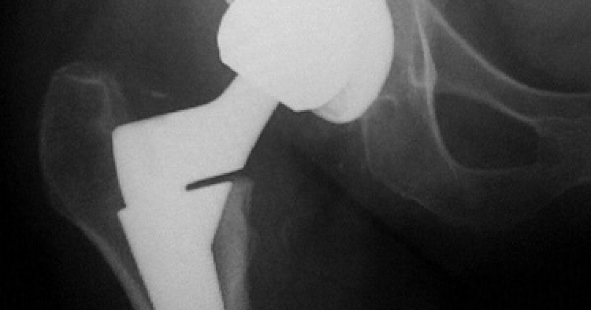 How Much Is That Titanium Knee In The Window? New Hampshire Public Radio