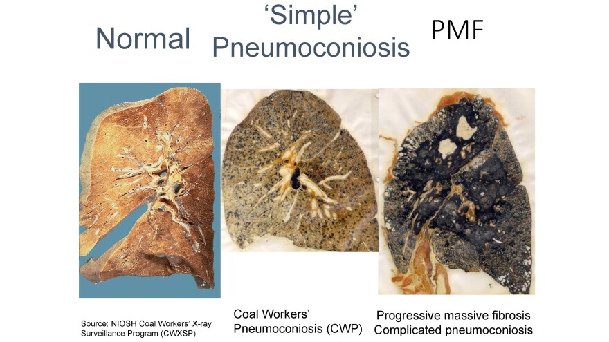 A slide from a presentation by the National Institute for Occupational Safety and Health shows the progression from a healthy lung to advanced black lung disease.